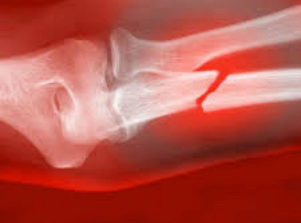 INSTANT BONE HEALING MACHINES ARE AVAILABLE