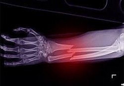 We heal the broken bones easier than ever before